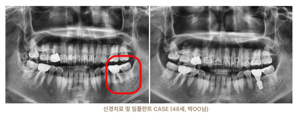 종로치과 더스퀘어치과 임플란트