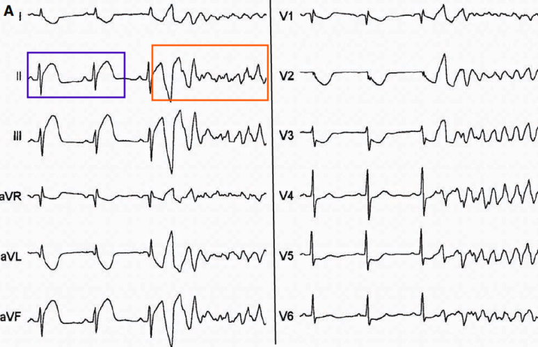 Ischemic VT 심전도