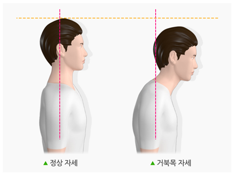 &lt;정상자세와 거북목 자세&gt;