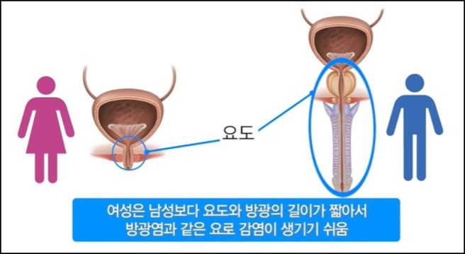 방광염 증상