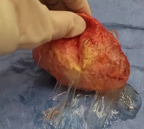 이런! 성형 시술 의사가 10년 후 고객의 유방 보형물을 꺼냈더니..VIDEO: TikTok surgeon removes woman&#39;s 35-year-old breast implants