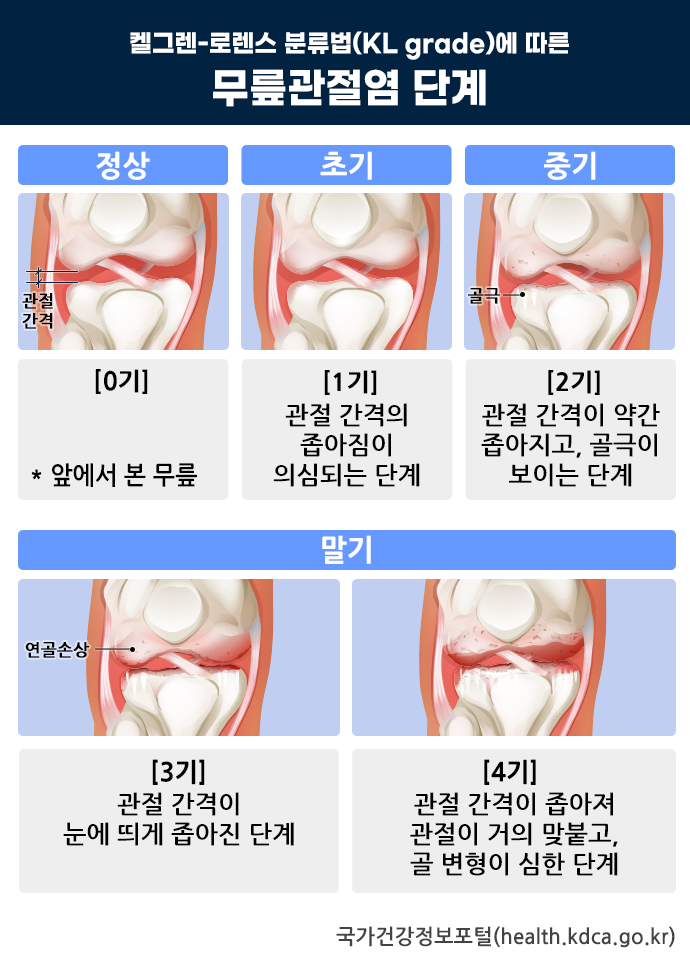 무릎관절염 단계