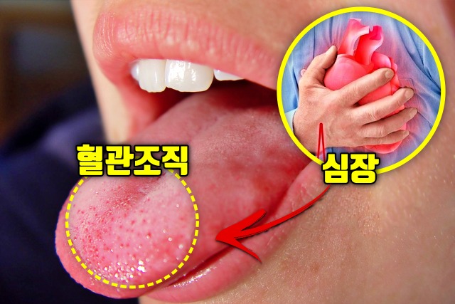 혀 오돌도돌 설유두 돌연사 전조증상 혀 증상