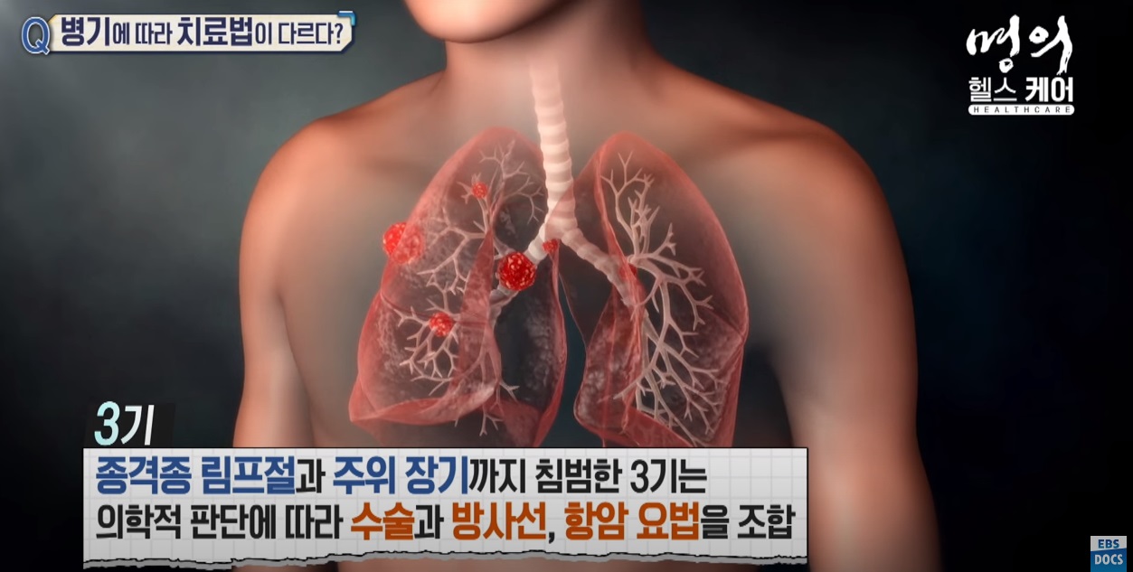 - 폐암3기 치료방법