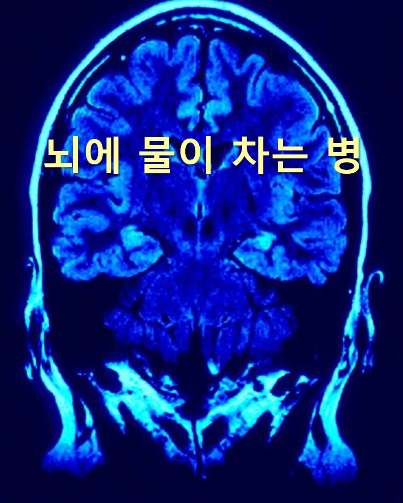  뇌에 물이 차는 병 수두증 원인과 뇌에 산소부족일 때 나타나는 증상
