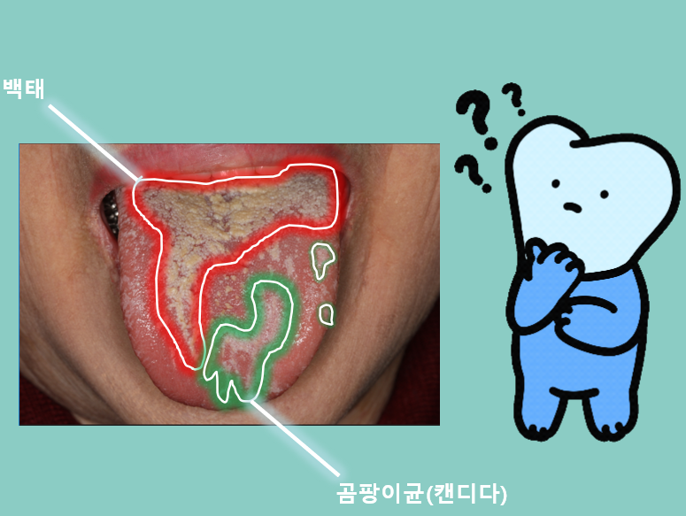 혀 클리너 사용법, 혀 백태가 생기는 이유와 제거까지 구강내과의사가 알려드림