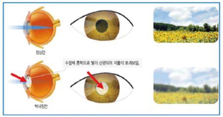 백내장