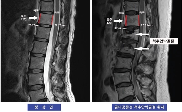 골가공증성 척추 압박 골절 (출처:메디칼업저버)