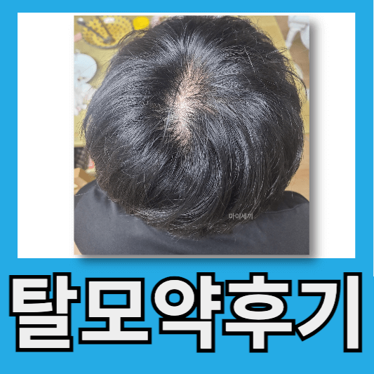 30대 탈모시작 프로페시아 3개월 후기 피나모아 후기 탈모약 6개월 및 로메인폼 후기