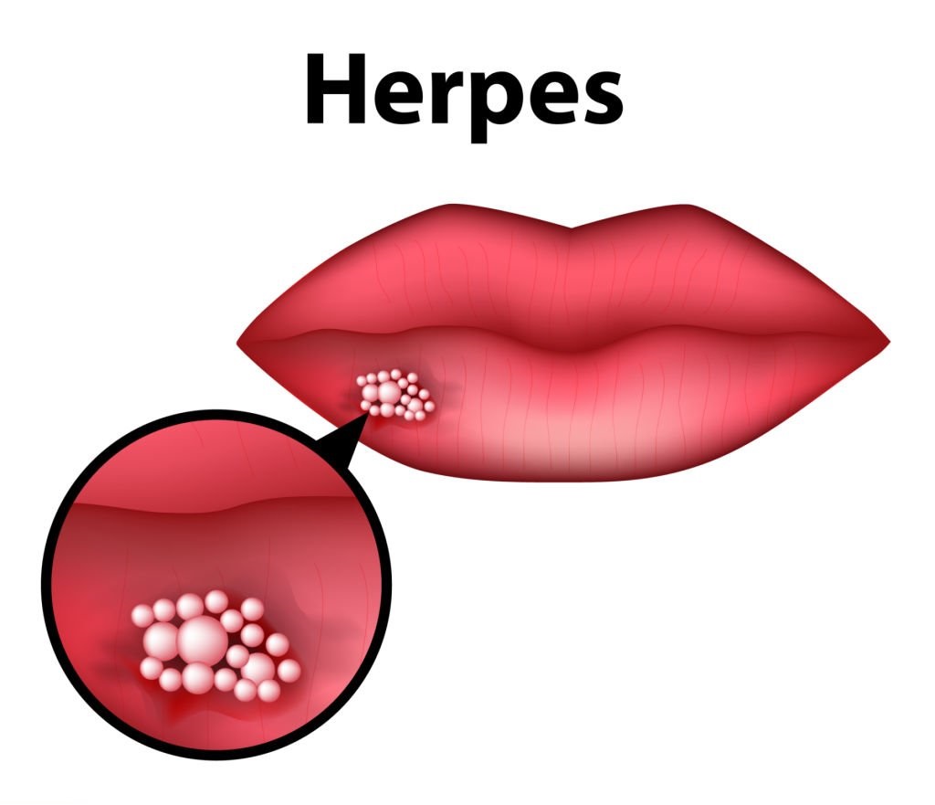 헤르페스 1형&#44; 헤르페스 2형 증상 치료방법