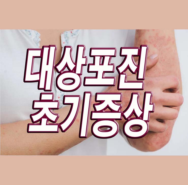  대상포진 초기증상, 예방접종 가격