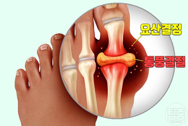 통풍 초기 증상 엄지발가락 통증 원인 통풍 증상 통풍 결절 관절 변형