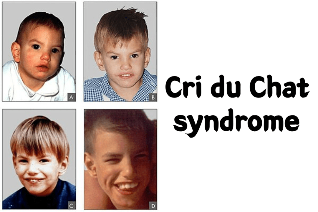 Cri du Chat syndrome