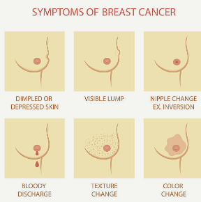 유방암 수술 후 회복 기간