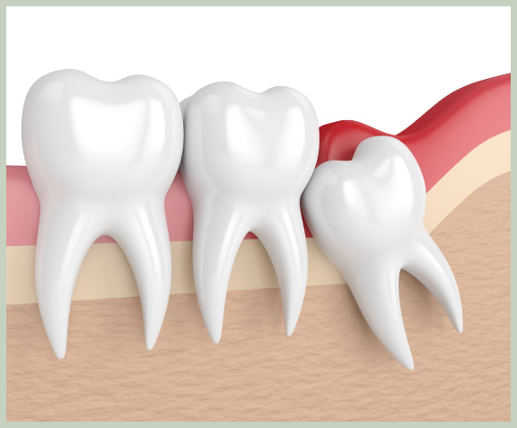 사랑니 발치 이유