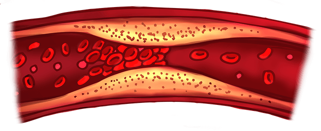 혈관 콜레스테롤 사진