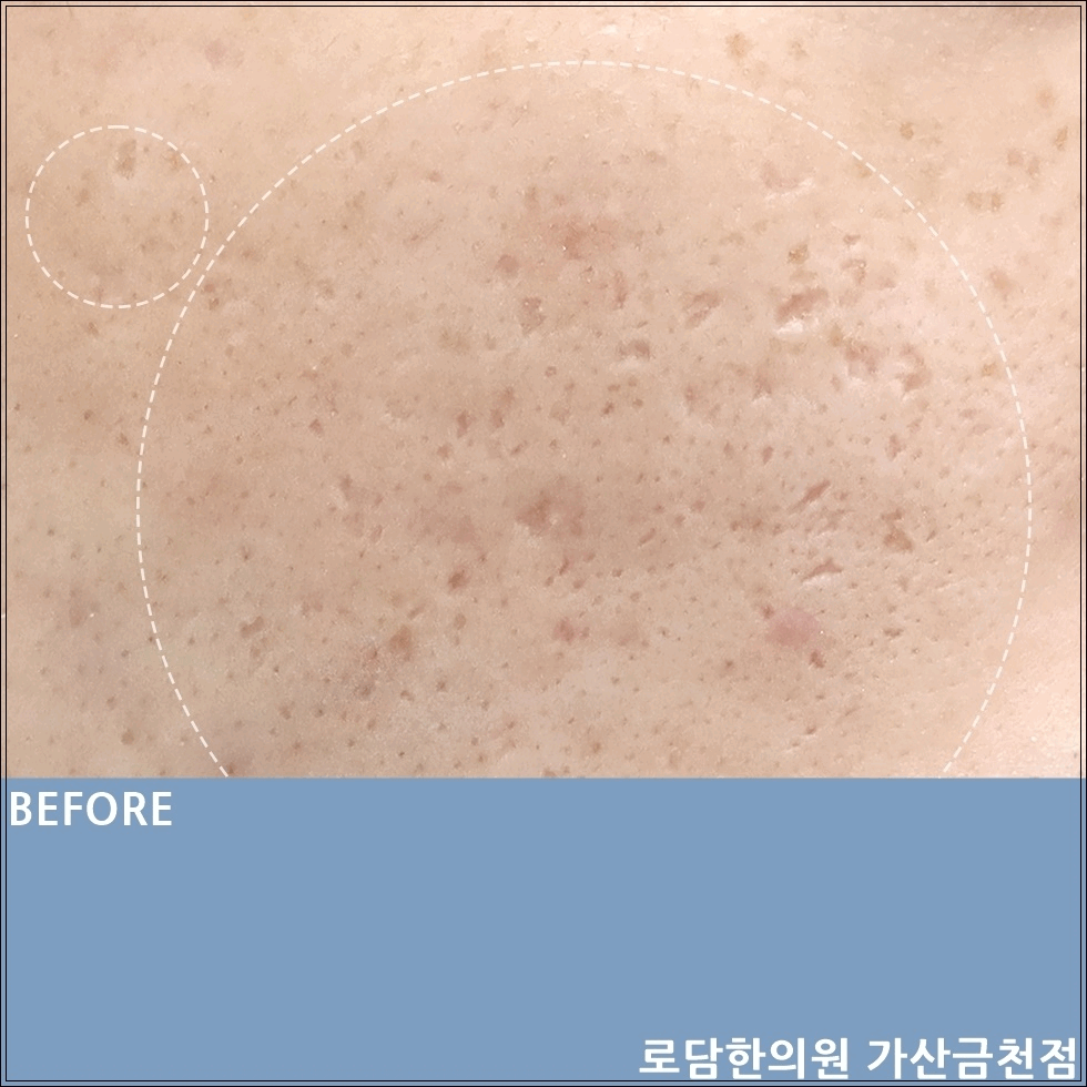  패인 여드름 흉터 피부 치료 피부과가 아닌 한의원에서