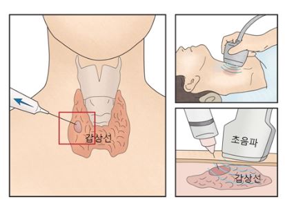 갑상선-세침-검사