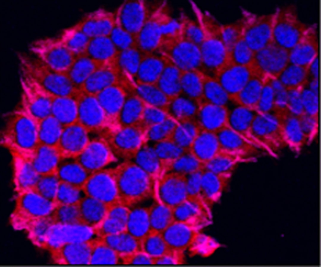 Basal cell carcinoma.