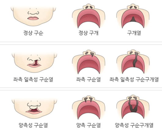 구순구개열