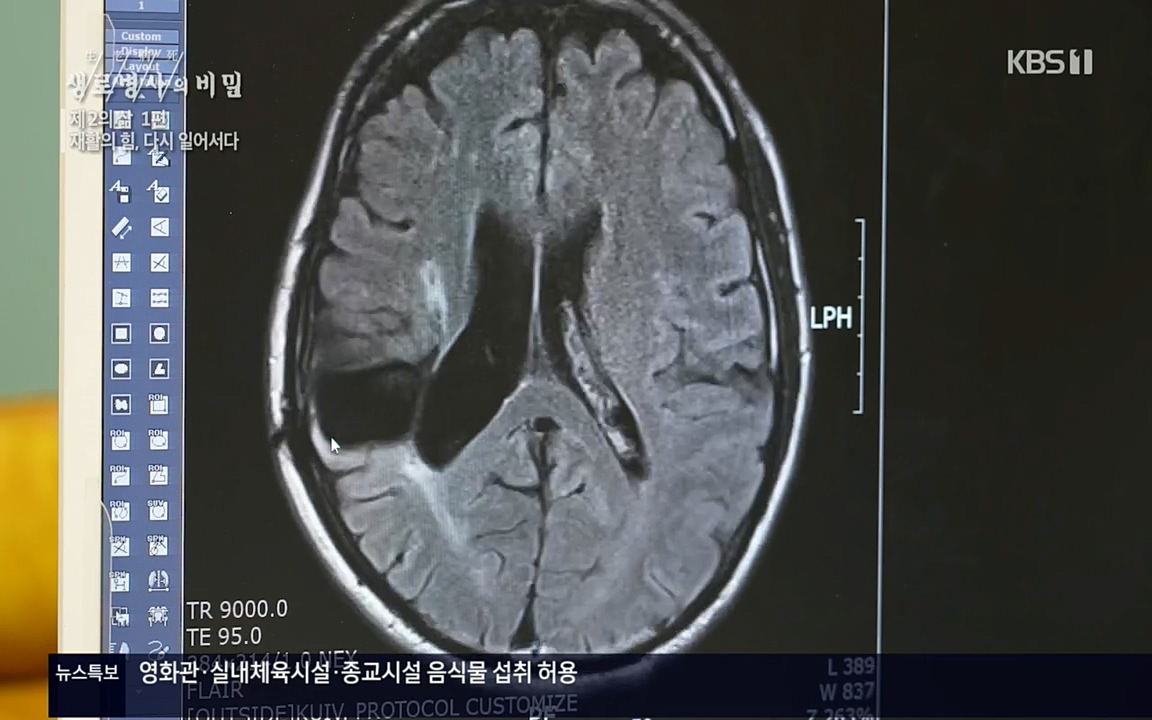 생로병사의 비밀.E819.220505p.H264-F1RST.mp4_20220508_182656.334.jpg