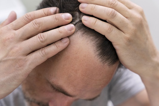 Non-face-to-face-treatment-for-hair-loss-medication