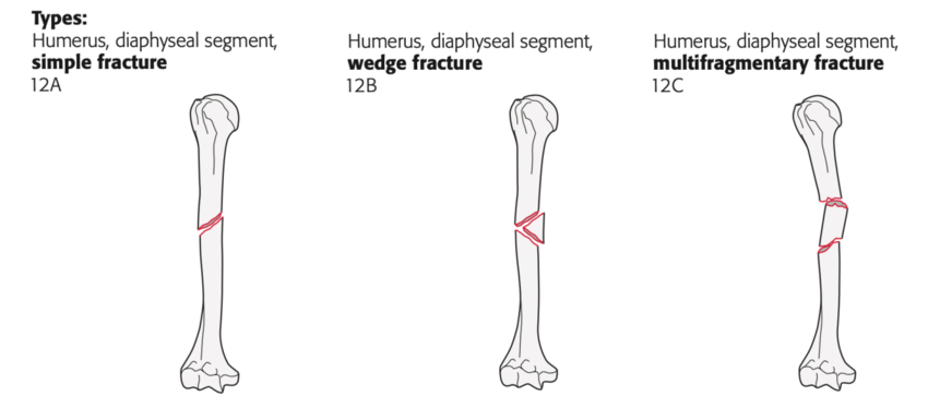 상완부 간부 골절의 분류