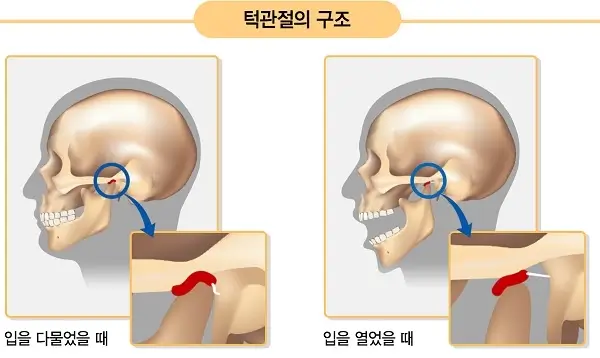  어금니 꽉 깨물면 귀가 아픈 이유: 턱관절 질환일까?