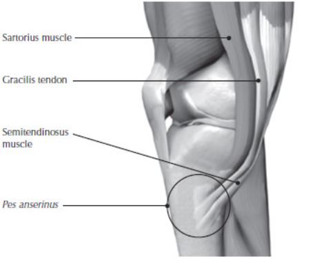 거위발건염을 일으키는 근육 3가지의 이름과 통증 포인트를 나타낸 그림