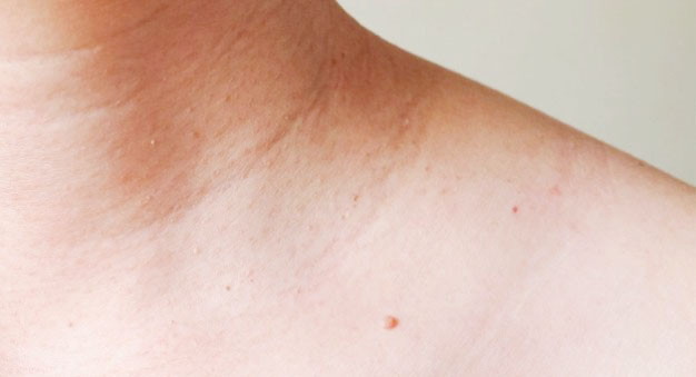 쥐젖이 생기는 이유, 제거방법