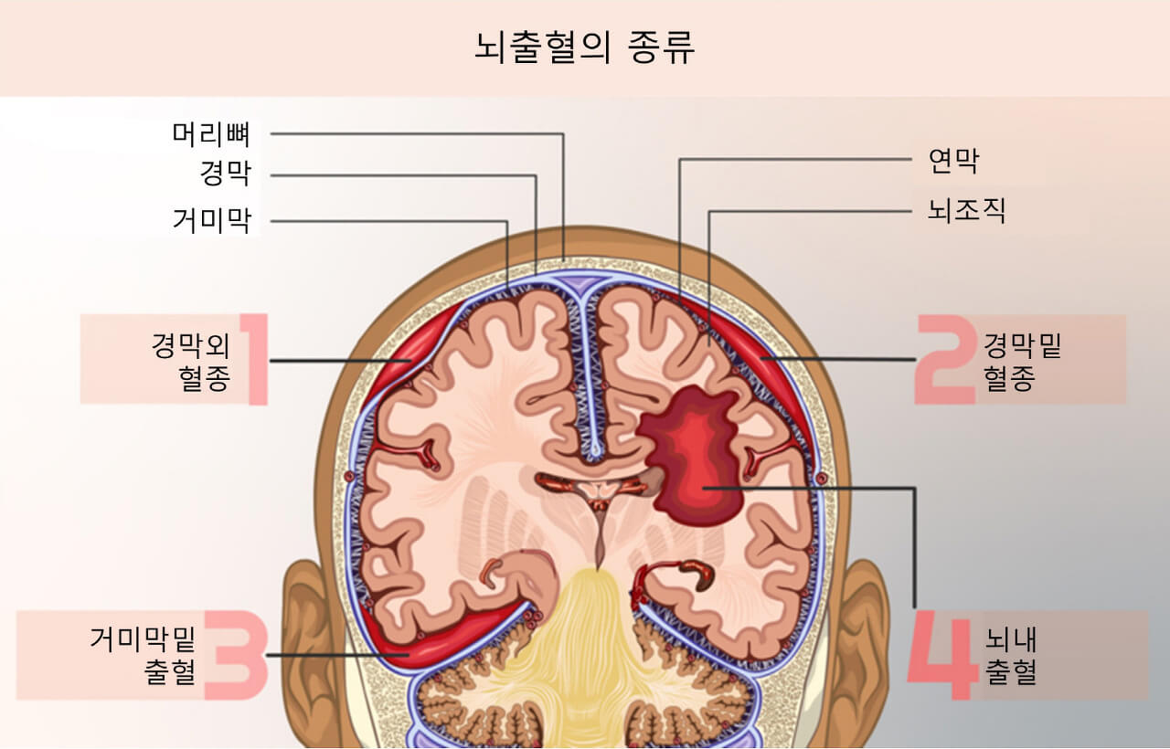 의학용어 ICH 뜻 Intracerebral hemorrhage 경막외출혈 경막밑출혈 거미막밑출혈 뇌내출혈 치료법