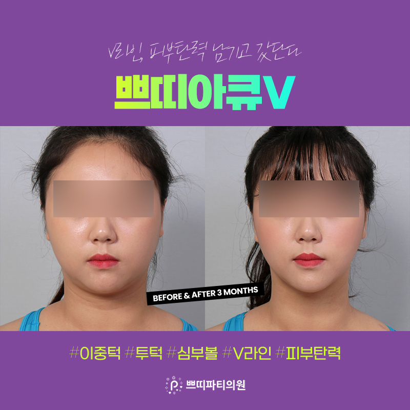  얼굴지방흡입비용 얼굴살빼는법 어려움을 겪고있나요?