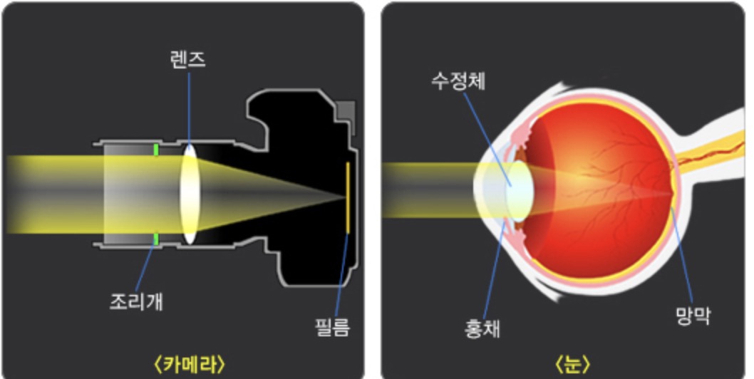 백내장-증상-2