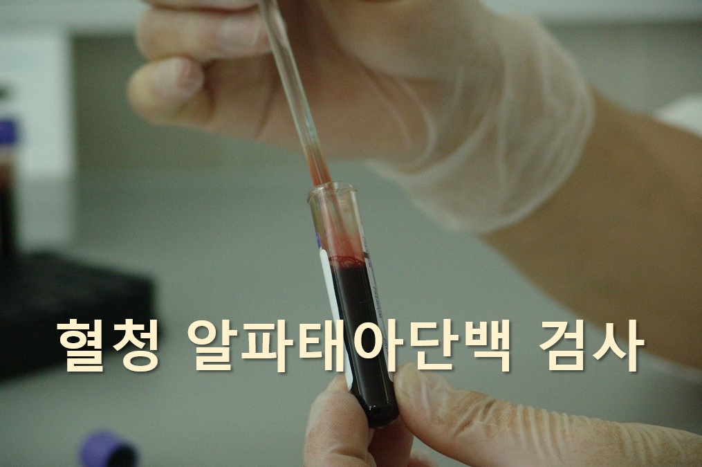  간 손상 및 간세포암을 진단하는 혈청 알파태아단백 검사(AFP)