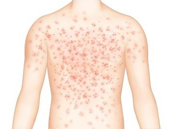  홍역(Measles)