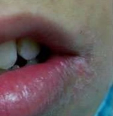 입 벌릴 때마다 입술 양쪽 통증... 구석입술염