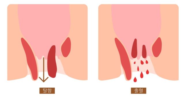 항문에서 피가나는 이유