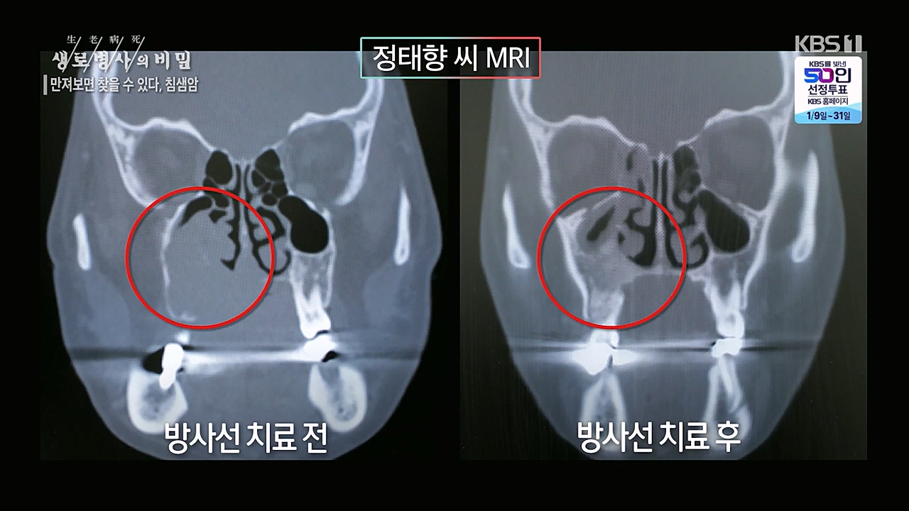 생로병사의 비밀.E851.230112p.H264-F1RST.mp4_20230119_200637.859.jpg