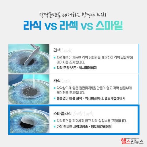  시력교정하는 안과 해고당하면서 알려주는 tmi