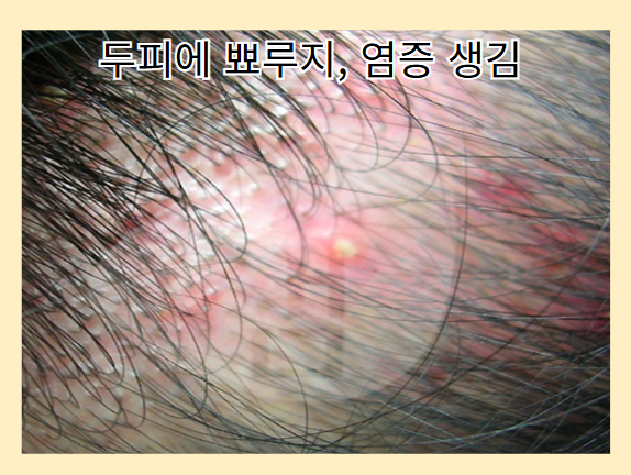 탈모 증상 - 두피에 뾰루지&amp;#44;염증 생김