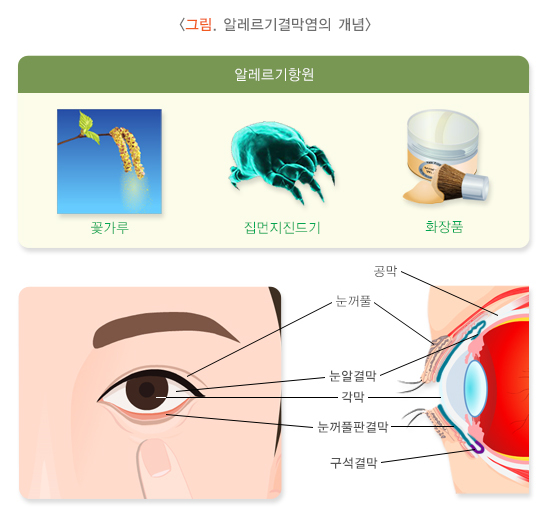  알레르기결막염 증상과 원인 및 치료 방법