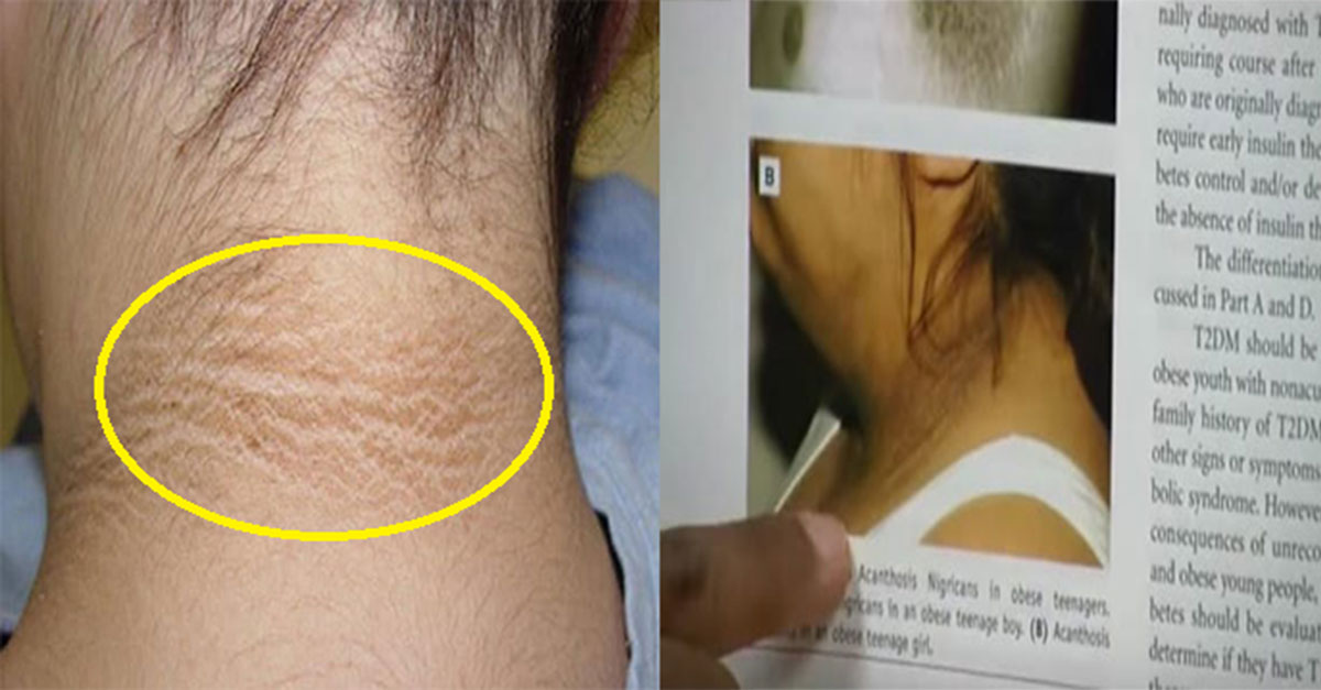  목 뒤에 검은색 튼 살이 있다면 병원 가봐야 하는 이유