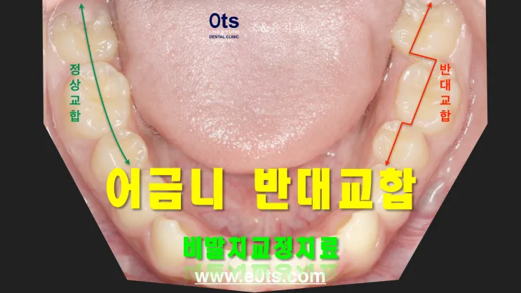 어금니 칫솔 사용법 선택방법 실사용 후기_8
