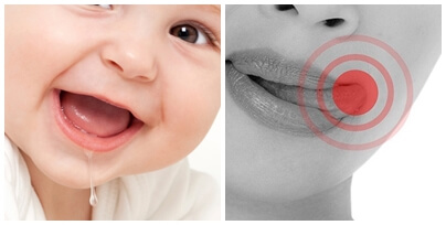 헤르페스 감기 염증