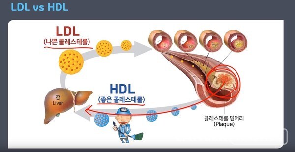 LDL(저밀도 지질단백질) 콜레스테롤에 실려 이동하는 콜레스테롤은 필요한 존재지만 너무 많을 때 문제가 생깁니다.