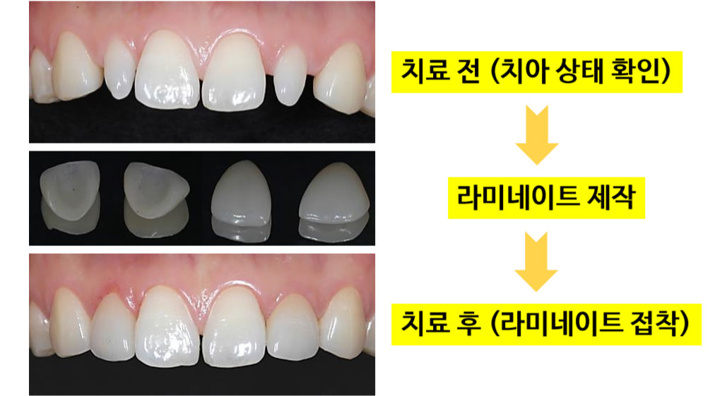 덴탈 라미네이션 공정, 기간, 가격, 단점 덴탈 라미네이션 공정, 기간, 가격, 단점