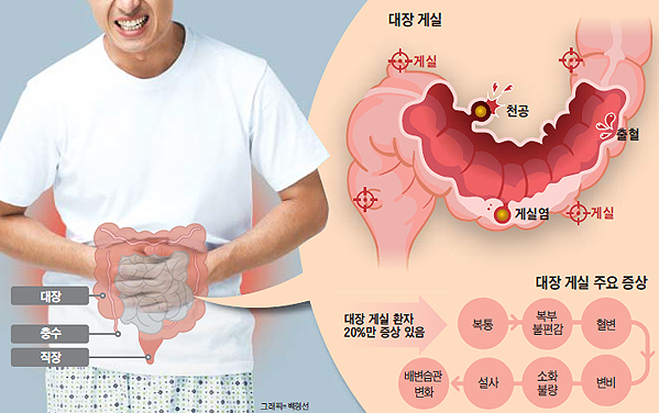  대장게실염 증상 수술하기전에 꼭 확인하세요