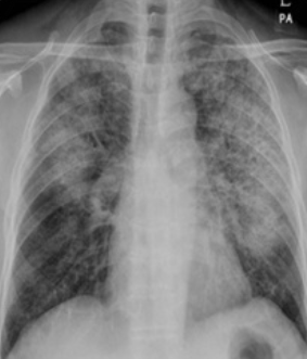 심인성 폐부종 방사선 사진