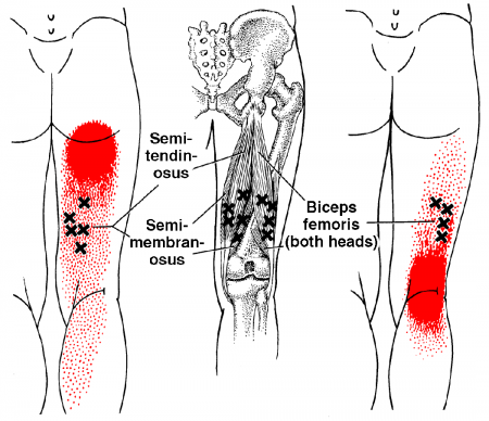 허벅지의 trigger point_넙다리 두갈래근