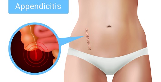 Appendicitis